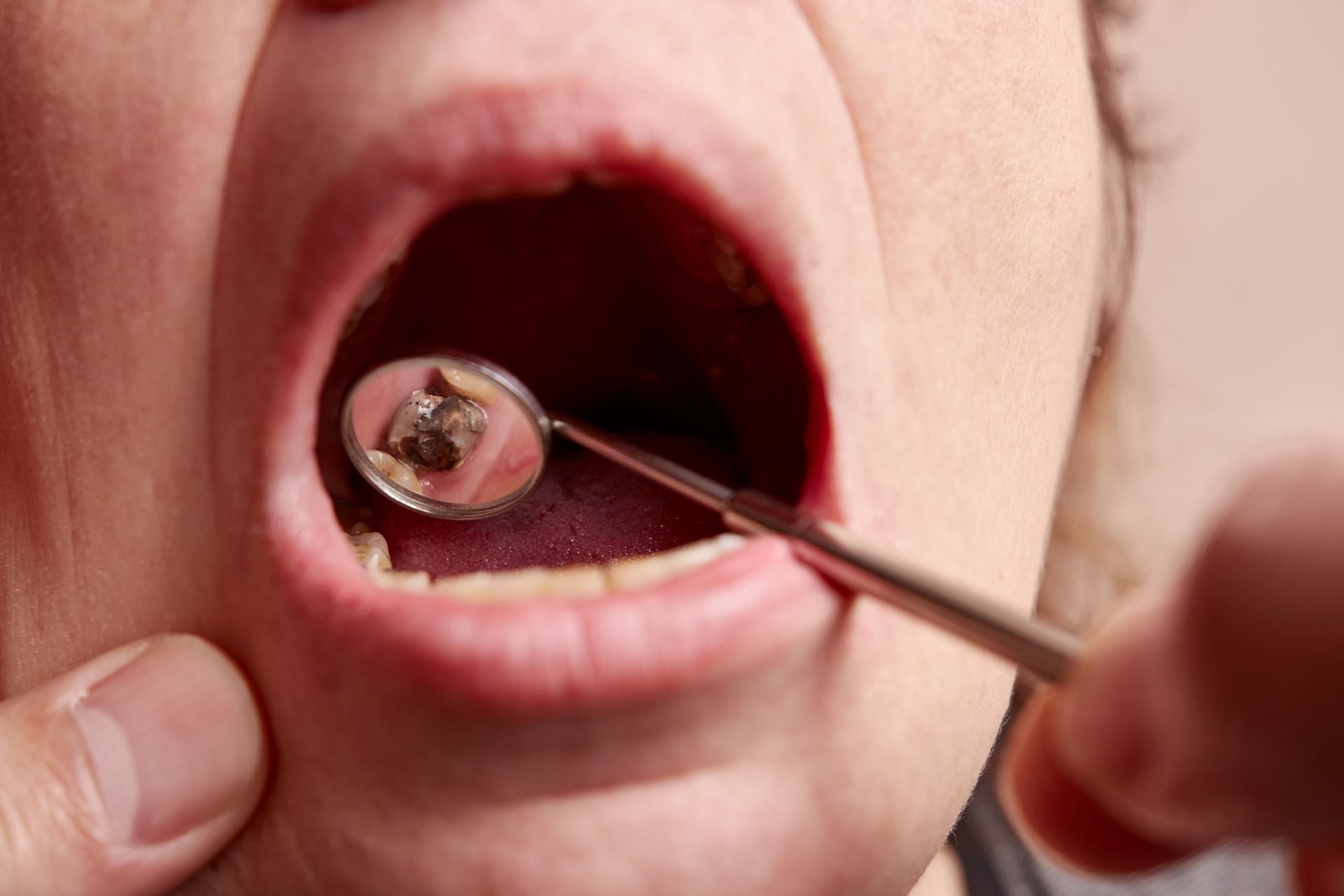 Oral Cancer Screening — what to know