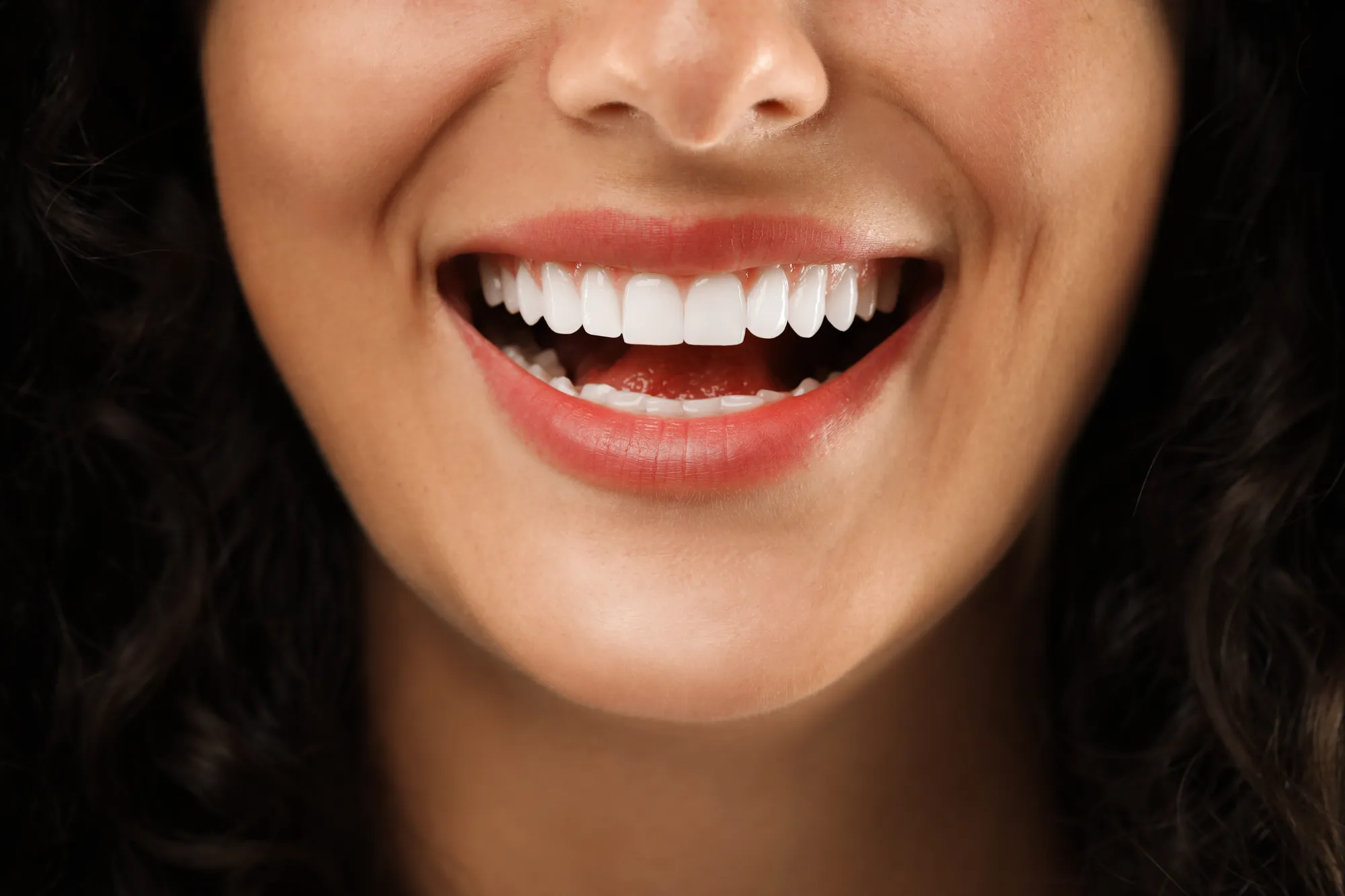 Veneers